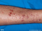 epidermolysis bullosa pruriginosa