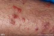 epidermolysis bullosa pruriginosa