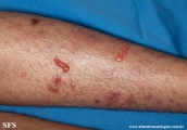 epidermolysis bullosa pruriginosa
