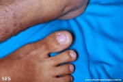 epidermolysis bullosa pruriginosa