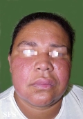 melkersson rosenthal syndrome