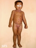 chronic bullous disease of childhood
