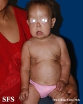 cutis laxa