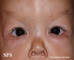cutis laxa