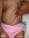 cutis laxa