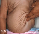 cutis laxa