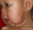 cutis laxa