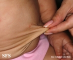 cutis laxa