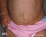 cutis laxa