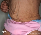 cutis laxa