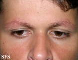 ulerythema ophryogenes