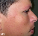 ulerythema ophryogenes