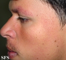 ulerythema ophryogenes
