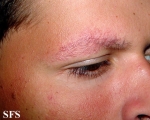 ulerythema ophryogenes
