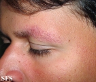 ulerythema ophryogenes