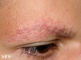ulerythema ophryogenes