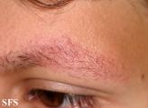 ulerythema ophryogenes