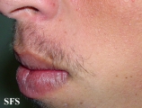 ulerythema ophryogenes