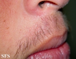 ulerythema ophryogenes