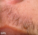 ulerythema ophryogenes