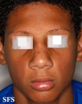 ulerythema ophryogenes