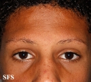 ulerythema ophryogenes