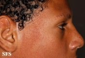 ulerythema ophryogenes