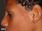 ulerythema ophryogenes