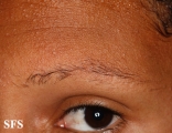 ulerythema ophryogenes