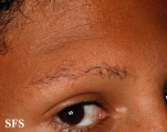 ulerythema ophryogenes