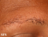 ulerythema ophryogenes