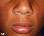 ulerythema ophryogenes