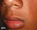 ulerythema ophryogenes