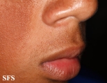 ulerythema ophryogenes