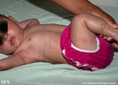 incontinentia pigmenti
