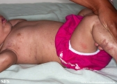 incontinentia pigmenti