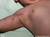 incontinentia pigmenti