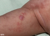 incontinentia pigmenti