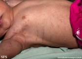 incontinentia pigmenti