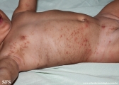 incontinentia pigmenti
