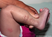 incontinentia pigmenti