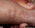 incontinentia pigmenti