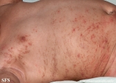 incontinentia pigmenti
