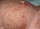 incontinentia pigmenti