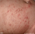 incontinentia pigmenti