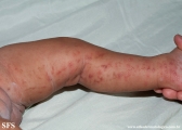 incontinentia pigmenti