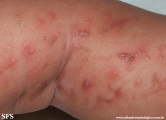 incontinentia pigmenti
