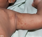 incontinentia pigmenti