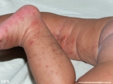 incontinentia pigmenti