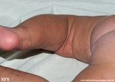 incontinentia pigmenti